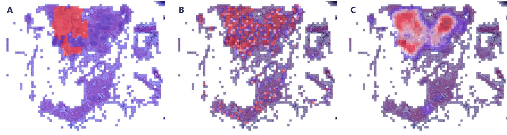 Three maps of the same breast-tissue slide: A, the annotated IDC region in red; B, the model's patch-level IDC probabilities, scattered across the slide; C, the same probabilities after adjustment, where dense regions in the upper part of the slide remain and the scattered hits on the lower part of the slide are gone